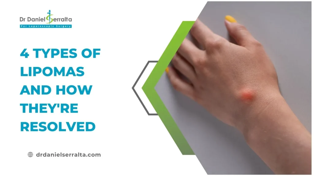 4 Types of Lipomas and How They’re Resolved 4 Types of Lipomas