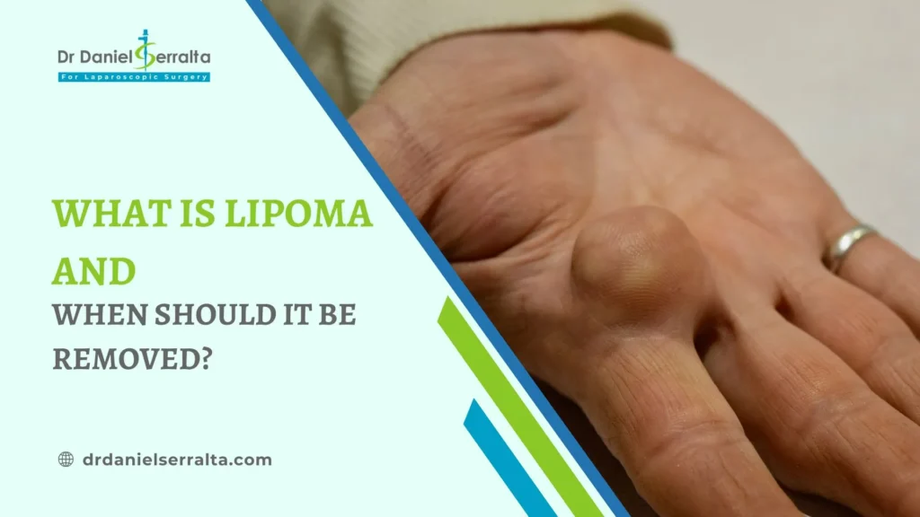 What Is Lipoma and When Should it Be Removed? 1 lipoma