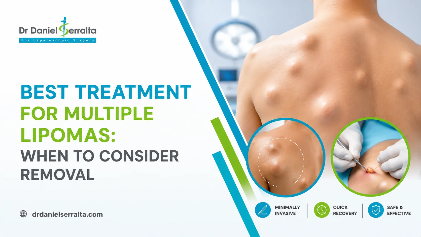 Multiple Lipomas Treatment