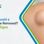 When Should a Lipoma Be Removed? Warning Signs to Watch