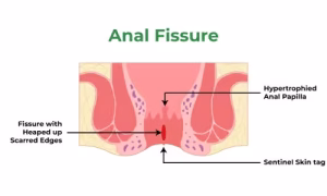Non Surgical Anal Fissure Treatment in Dubai: Healing Without Surgery 2 Anal Fissure Treatment in Dubai