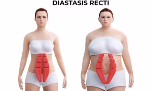 Diastasis Recti Surgery in Dubai