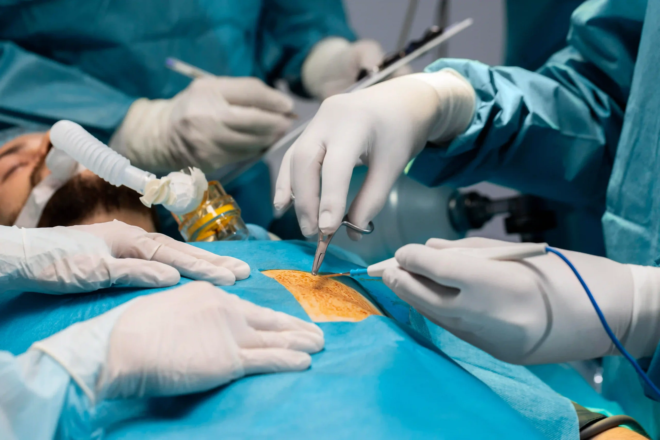 Recovery of Colorectal Cancer Surgery in Dubai